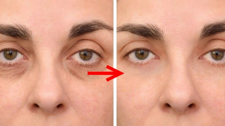 5 tratamientos que funcionan para eliminar las ojeras y rejuvenecer tu mirada