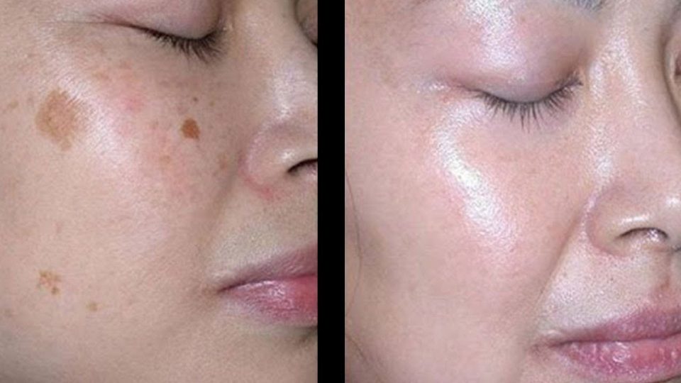 Cómo eliminar las manchas oscuras en la cara con 10 remedios caseros