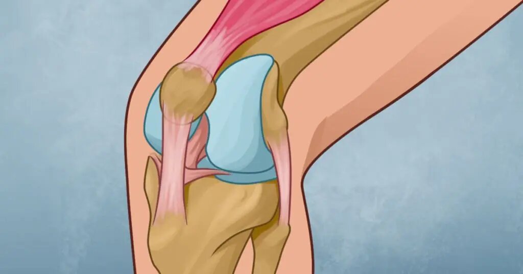¿Cómo sanar las rodillas y reconstruir la fuerza de las articulaciones?