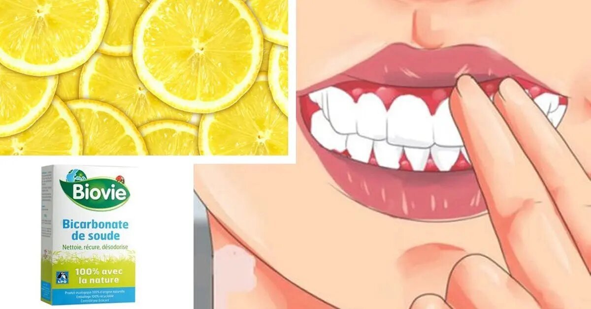 Aquí se explica cómo curar la gingivitis con aceite de coco, bicarbonato de sodio y limones