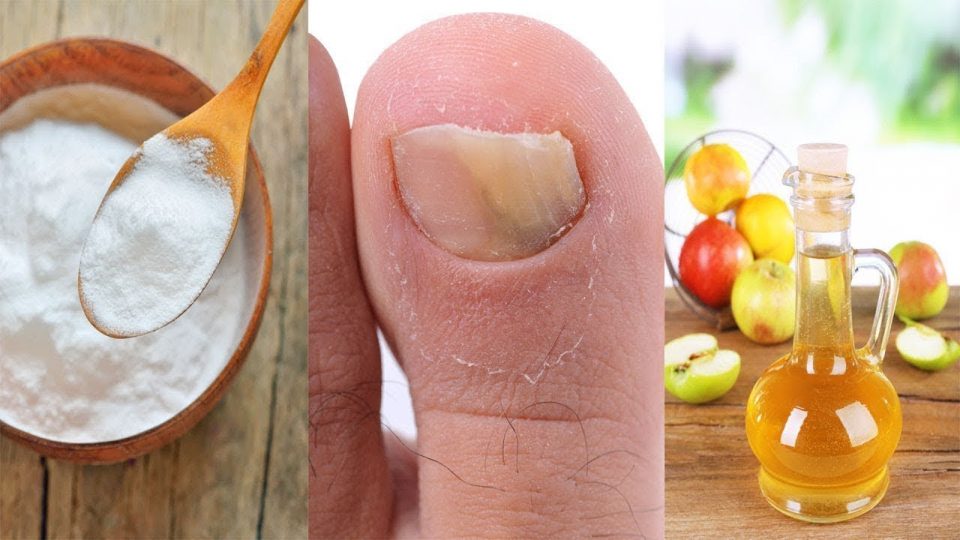 ¡Remedios caseros para eliminar los hongos en las uñas! Prueba estos remedios efectivos…