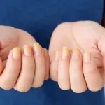 Cómo quitar las uñas amarillas de forma natural
