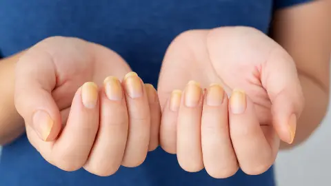Cómo quitar las uñas amarillas de forma natural