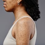 Cómo aclarar las manchas oscuras en la piel de forma natural