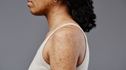 Cómo aclarar las manchas oscuras en la piel de forma natural